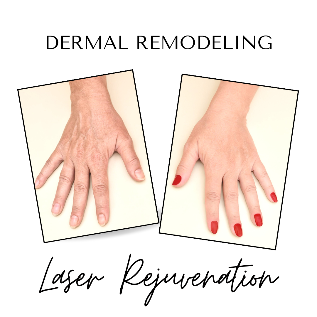 Laser hand treatment in St. Catharines