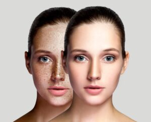 Laser Skin Rejuvenation Clinic St. Catharines